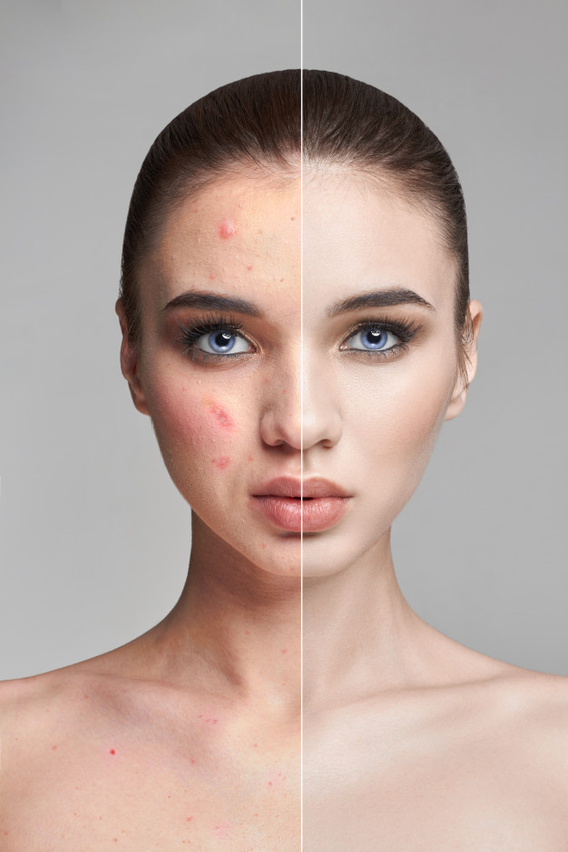 Laser Hair Removal