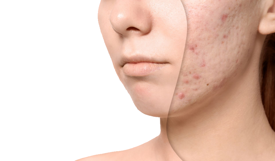 Acne Scar