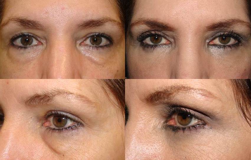 Eye Care