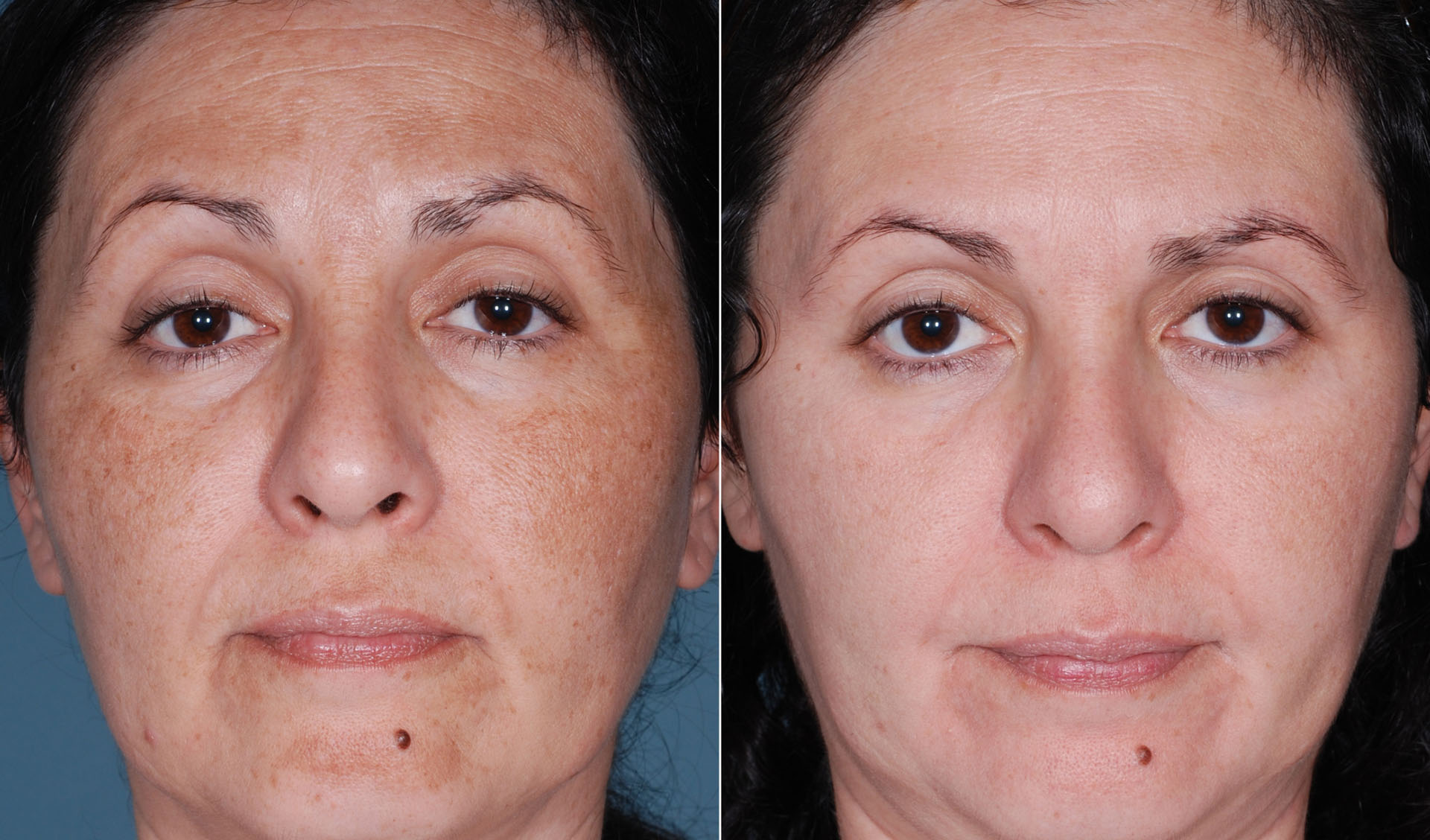 Pigmentation
