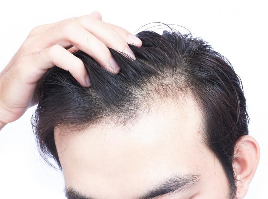 Why hair fall needs a scalp check first