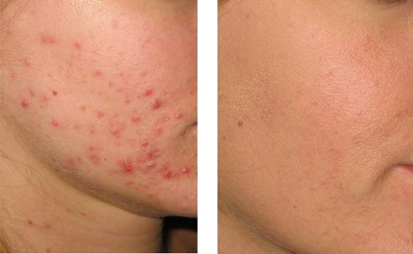 Acne and scar care at the clinic